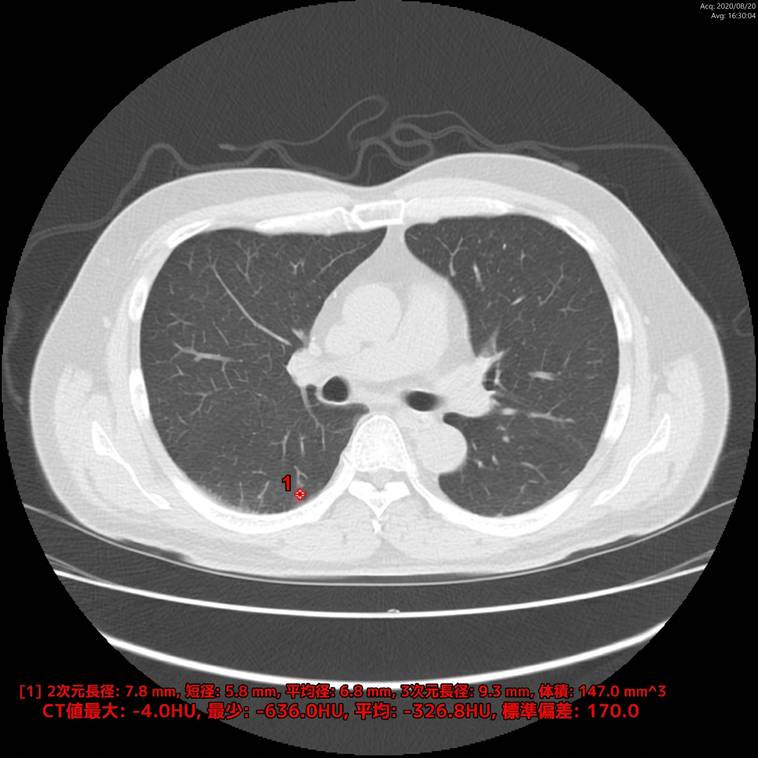 EIRL Chest CT2 解析画像サンプル